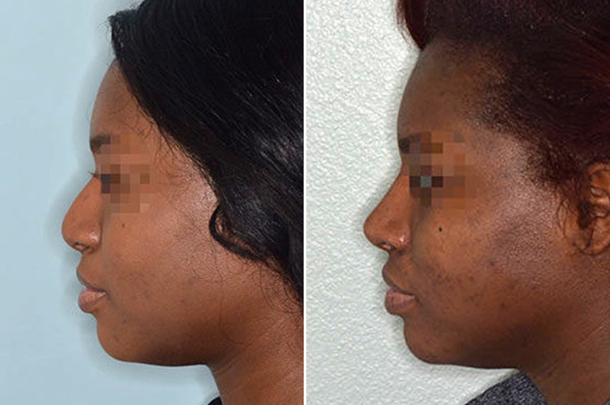 Ethnic Rhinoplasty before and after, lateral left.