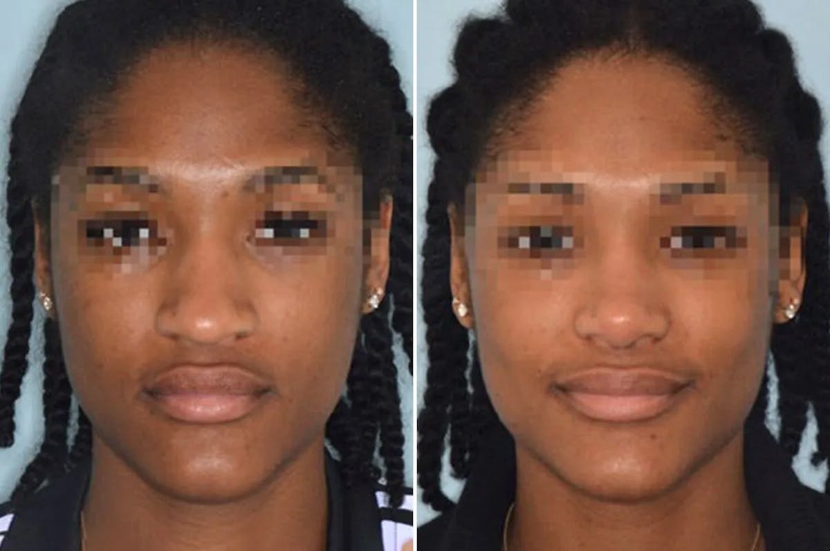 Ethnic Rhinoplasty before and after, frontal.