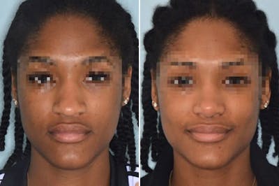 Ethnic Rhinoplasty before and after, frontal.
