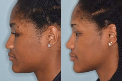 Ethnic Rhinoplasty before and after, lateral left.