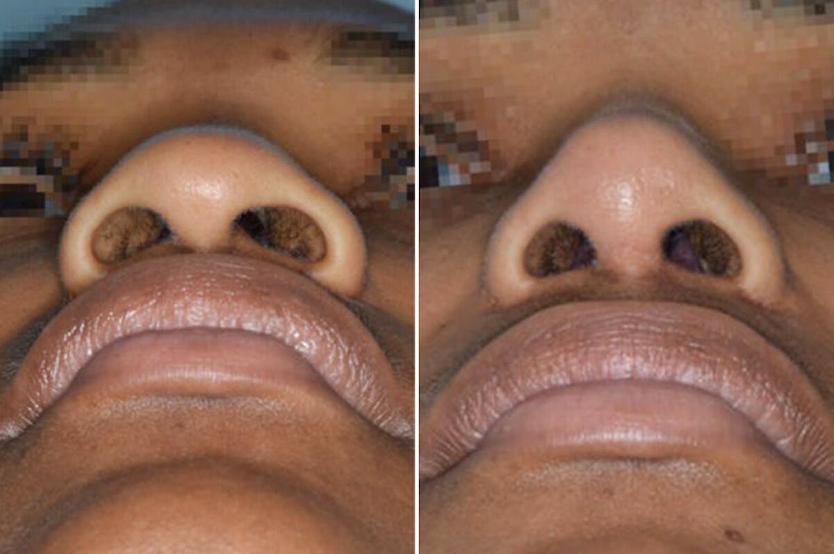 Ethnic Rhinoplasty before and after, frontal.