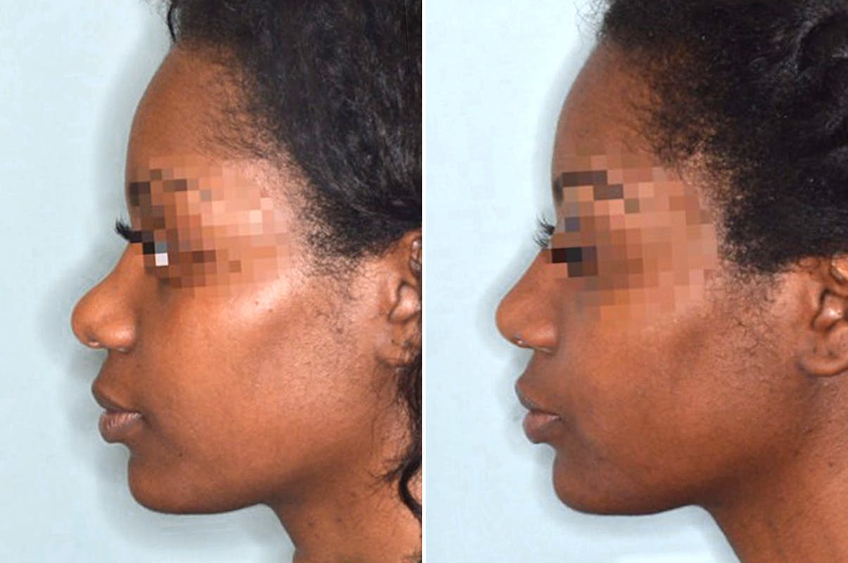 Ethnic Rhinoplasty before and after, lateral left.