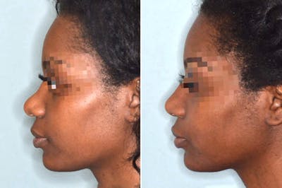 Ethnic Rhinoplasty before and after, lateral left.