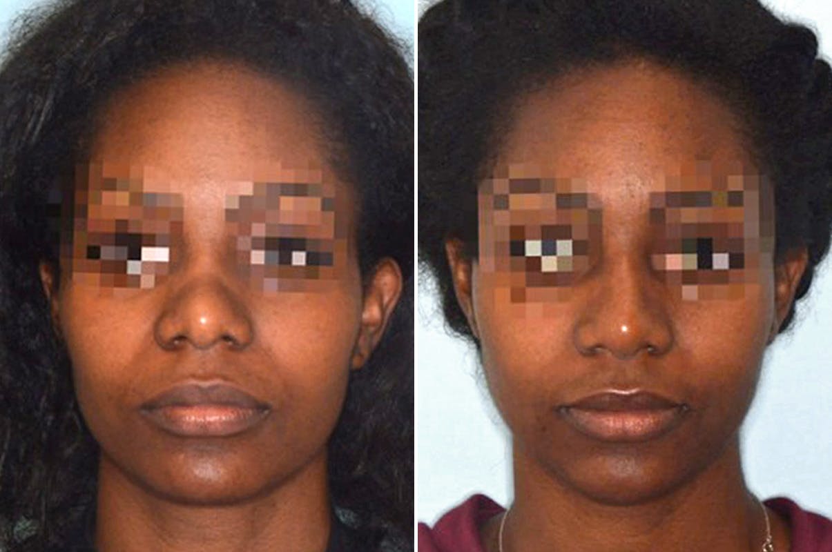 Ethnic Rhinoplasty before and after, frontal.