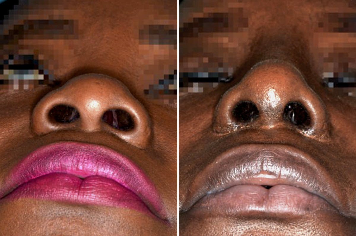 Ethnic Rhinoplasty before and after, frontal.