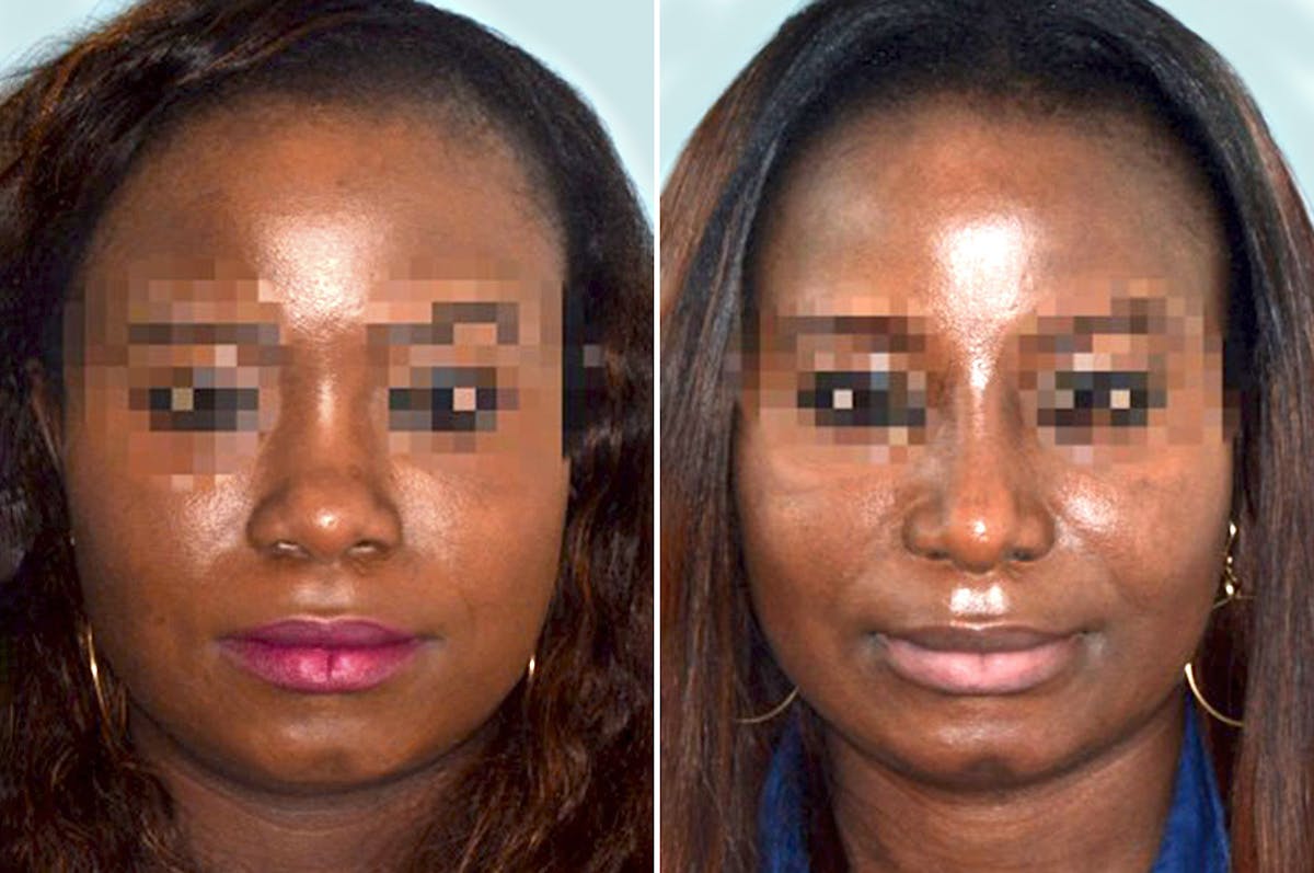 Ethnic Rhinoplasty before and after, frontal.