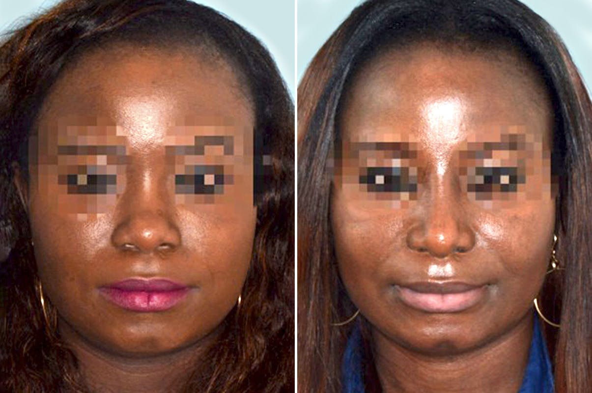 Ethnic Rhinoplasty before and after, frontal.
