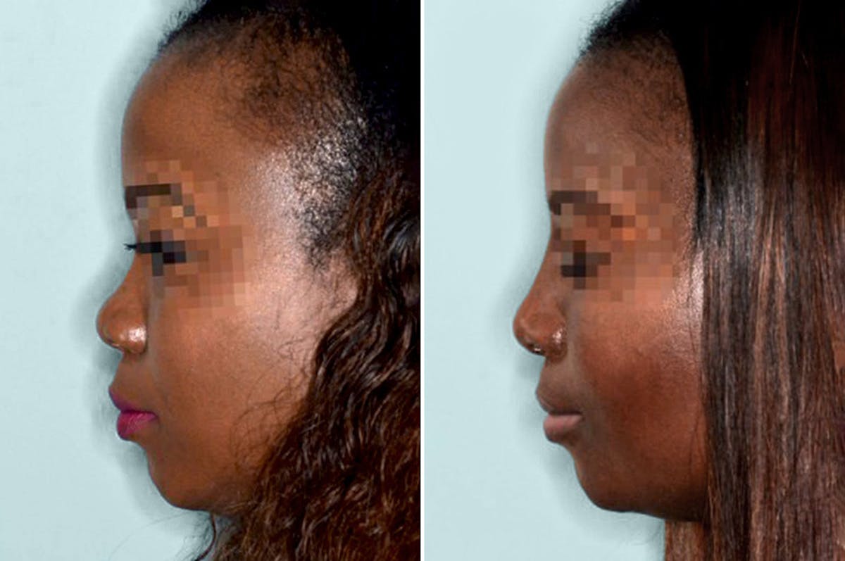 Ethnic Rhinoplasty before and after, lateral left.