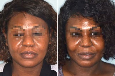 Ethnic Rhinoplasty before and after, frontal.