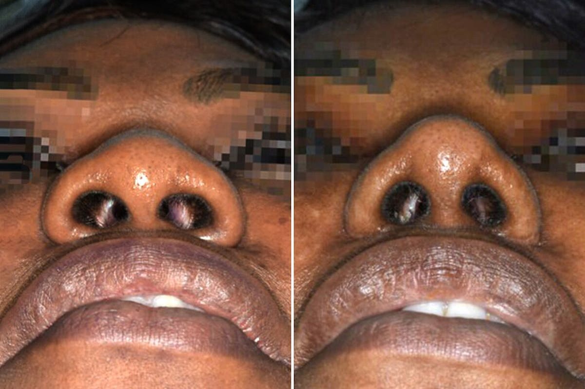 Ethnic Rhinoplasty before and after, frontal.