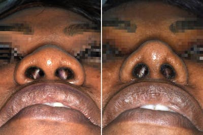 Ethnic Rhinoplasty before and after, frontal.
