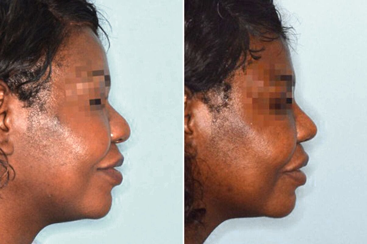 Ethnic Rhinoplasty before and after, lateral right.