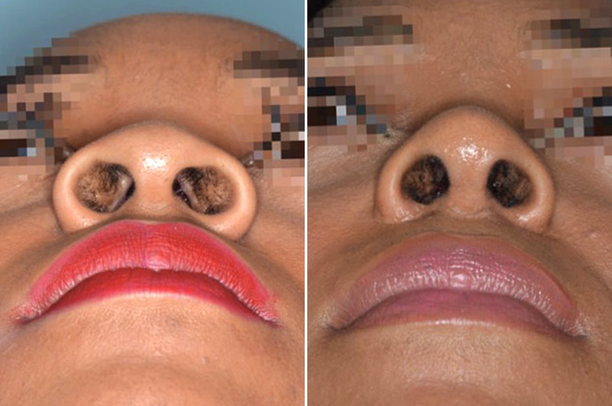 Ethnic Rhinoplasty before and after, frontal.
