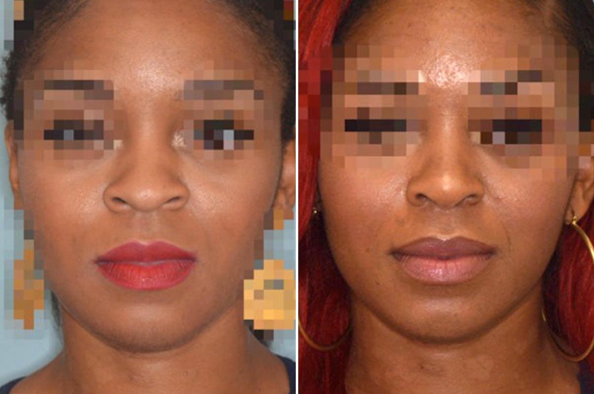 Ethnic Rhinoplasty before and after, frontal.