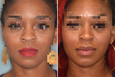 Ethnic Rhinoplasty before and after, frontal.