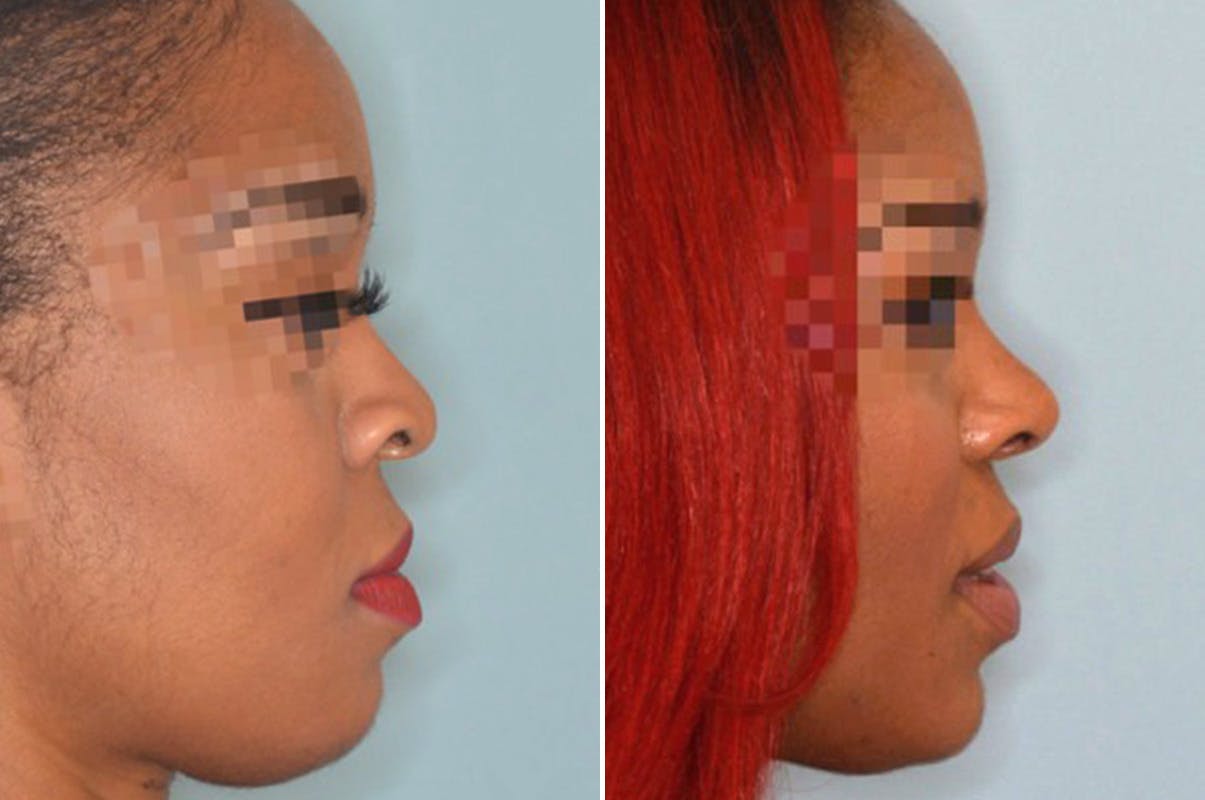 Ethnic Rhinoplasty before and after, lateral right.