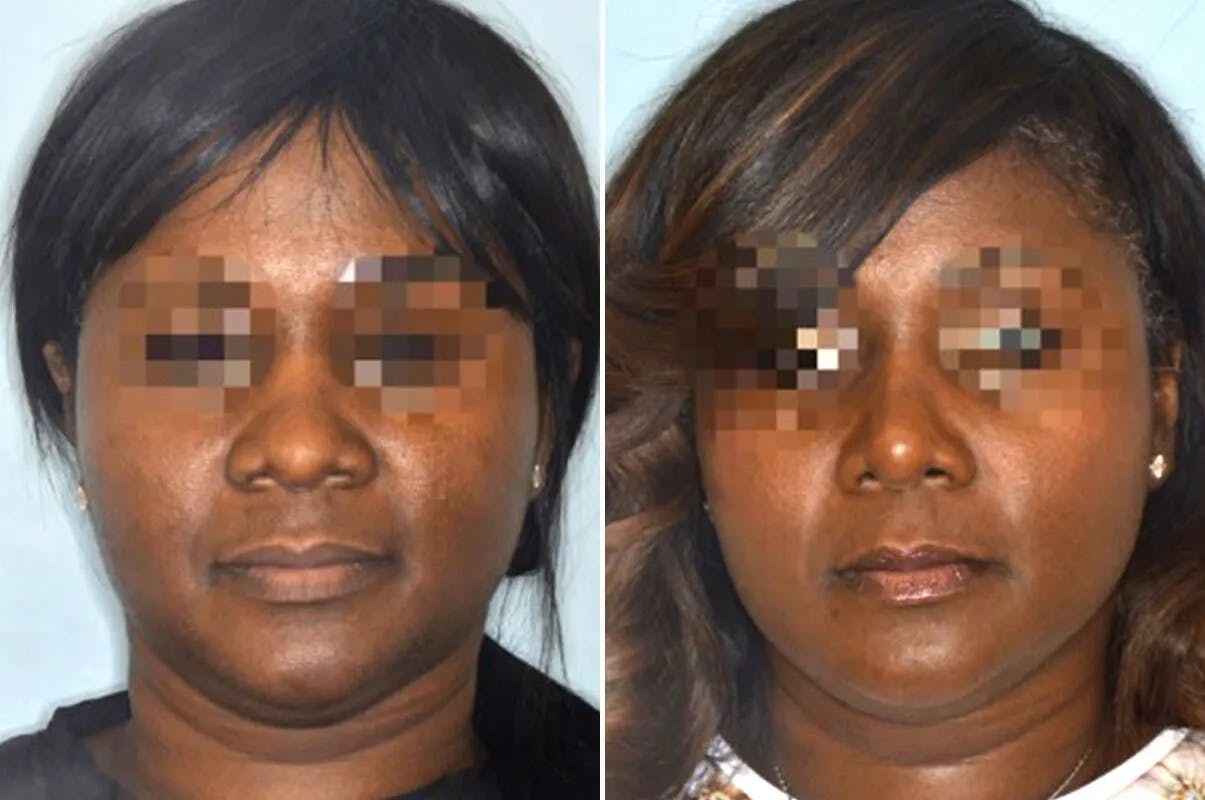 Ethnic Rhinoplasty before and after, frontal.