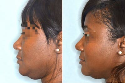 Ethnic Rhinoplasty before and after, lateral left.