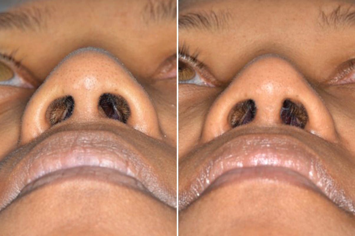 Ethnic Rhinoplasty before and after, frontal.