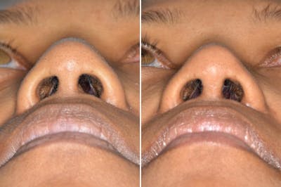 Ethnic Rhinoplasty before and after, frontal.