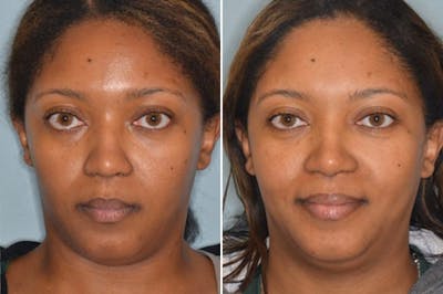 Ethnic Rhinoplasty before and after, frontal.