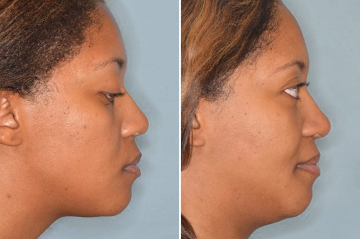 Ethnic Rhinoplasty before and after, lateral right.
