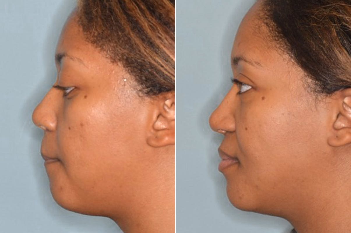 Ethnic Rhinoplasty before and after, lateral left.