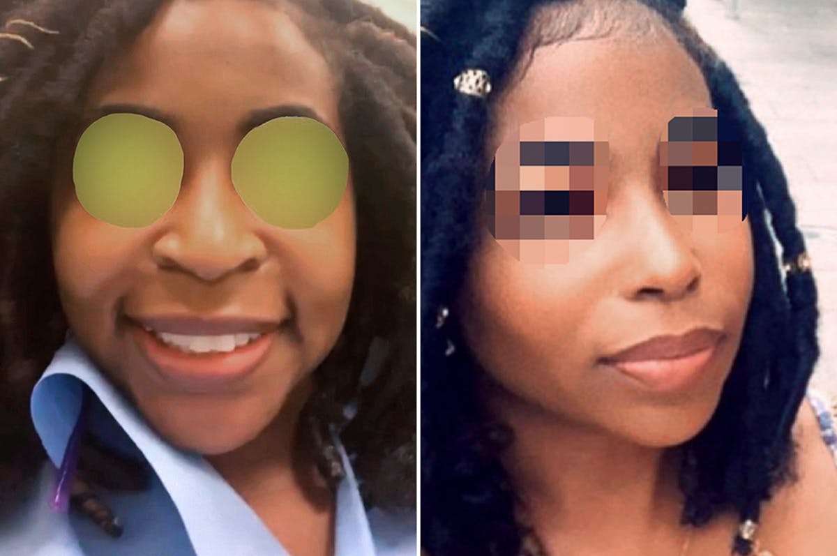 Ethnic Rhinoplasty before and after, frontal.