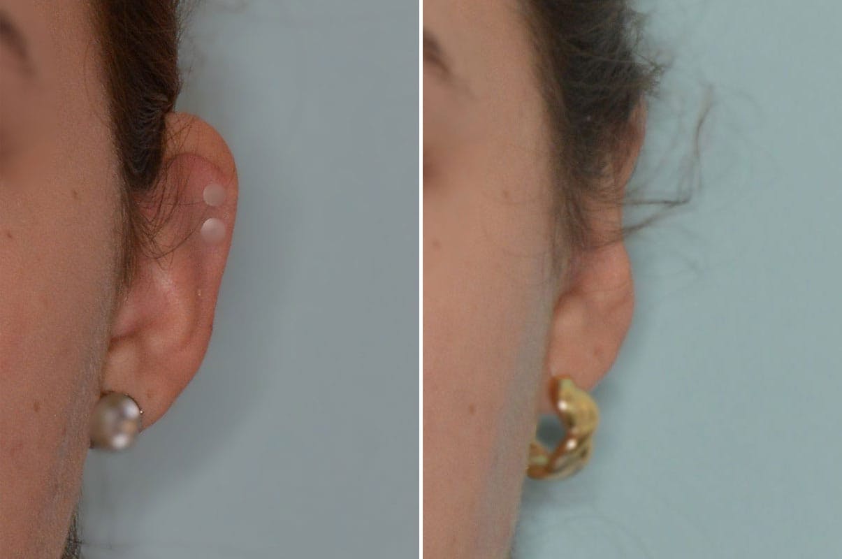 Otoplasty before and after, frontal. View of the left ear.