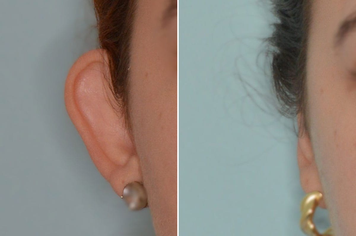 Otoplasty before and after, frontal. View of the right ear.