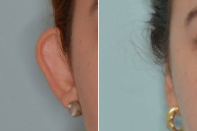 Otoplasty before and after, frontal. View of the right ear.