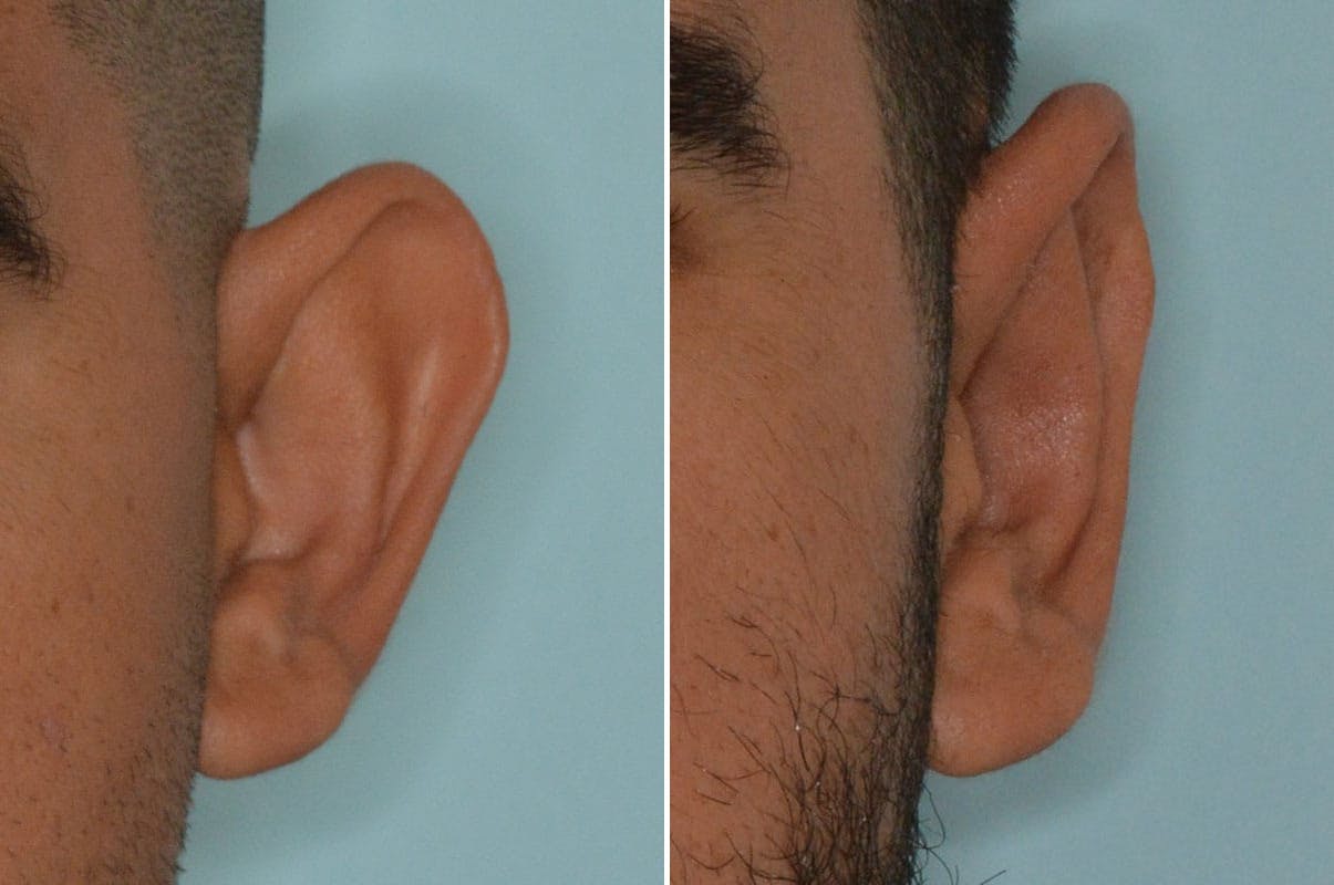 Otoplasty before and after, frontal. View of the left ear.