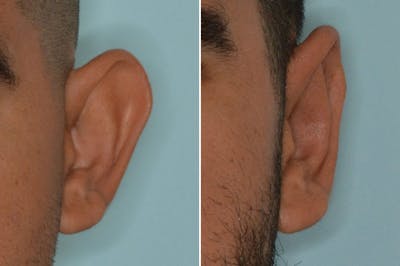 Otoplasty before and after, frontal. View of the left ear.