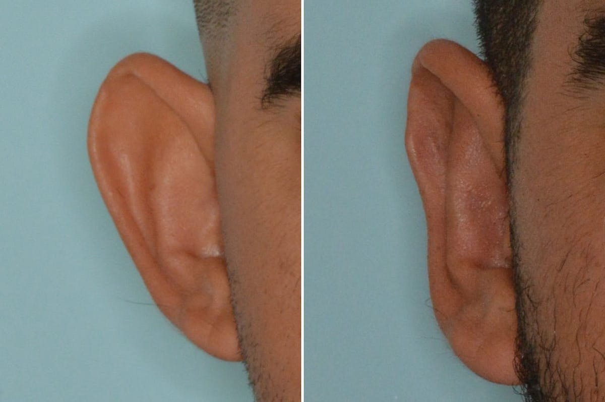 Otoplasty before and after, frontal. View of the right ear.