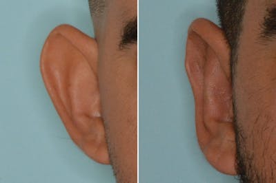 Otoplasty before and after, frontal. View of the right ear.