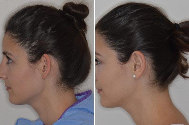 Otoplasty before and after, lateral left.
