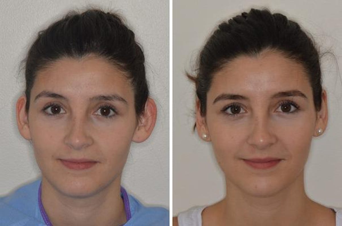 Otoplasty before and after, frontal.