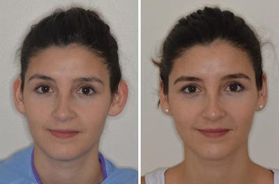 Otoplasty before and after, frontal.