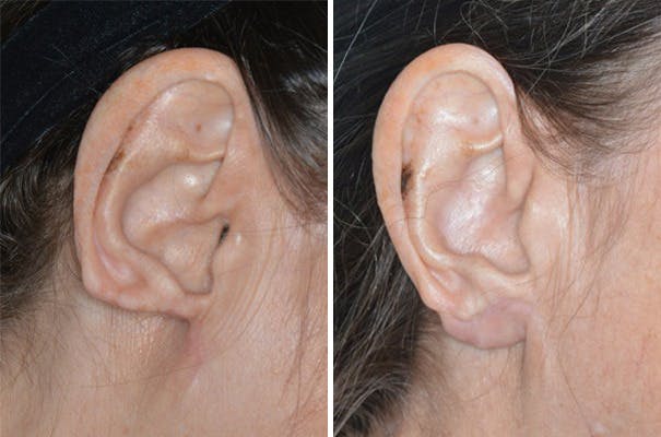 Otoplasty before and after, lateral right.