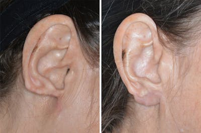 Otoplasty before and after, lateral right.