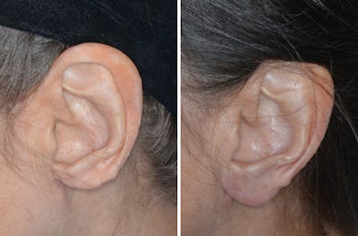 Otoplasty before and after, lateral left.