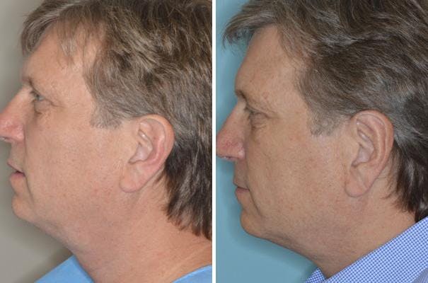 Otoplasty before and after, lateral left.