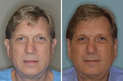 Otoplasty before and after, frontal.