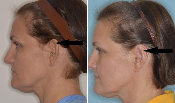 Otoplasty before and after, lateral left. Arrow in the photo demonstrates the location of the anti-helical fold before and after.
