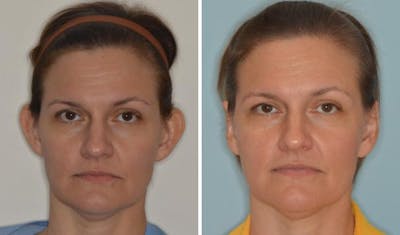 Otoplasty before and after, frontal.