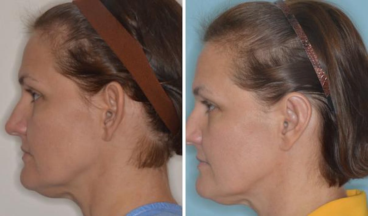 Otoplasty before and after, lateral left.