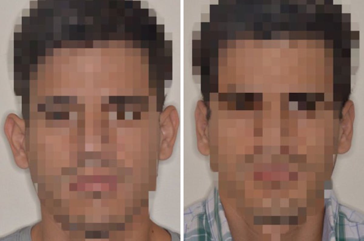 Otoplasty before and after, frontal.