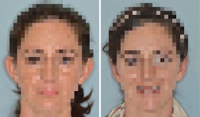 Otoplasty before and after, frontal.