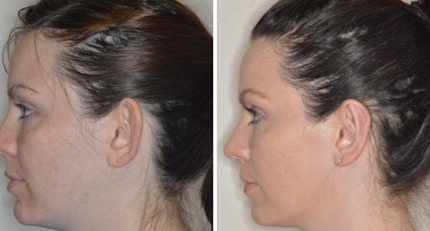 Otoplasty before and after, lateral left.