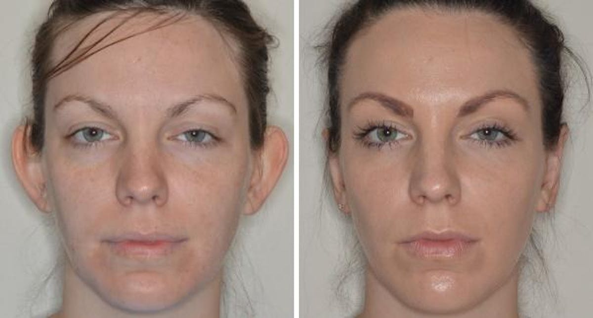 Otoplasty before and after, frontal.